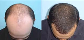 Hair Loss Before And After